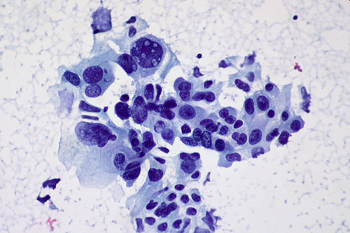 Lung Carcinoma