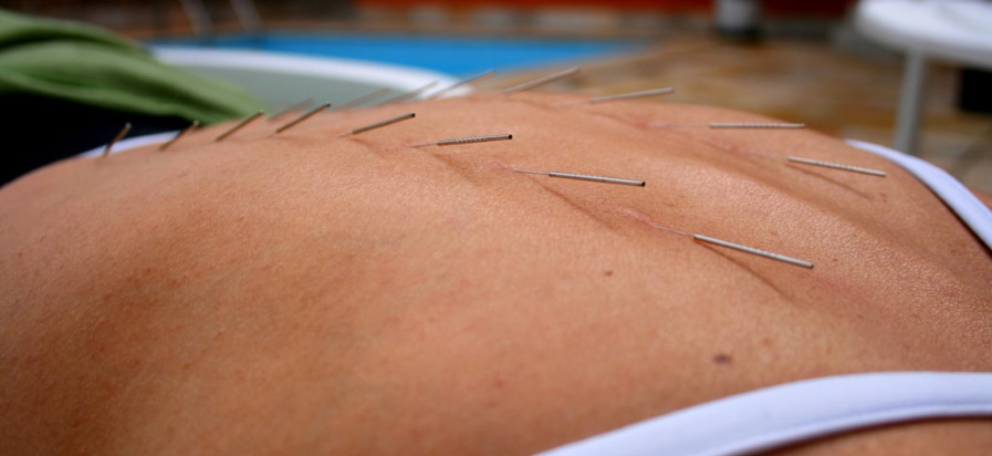A close-up of a woman getting acupuncture poolside.