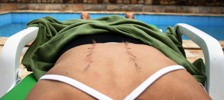 A woman enjoys acupuncture poolside.